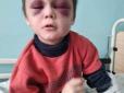 Моторошні кадри: На Вінниччині батько побив 6-річного сина до невпізнанності (фото)