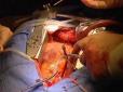 Хіти тижня. ​Австралійські хірурги вперше в історії медицини загасили вогонь у грудях пацієнта