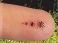 А ви це знали? Як укус кліща може спричинити алергію на м’ясо