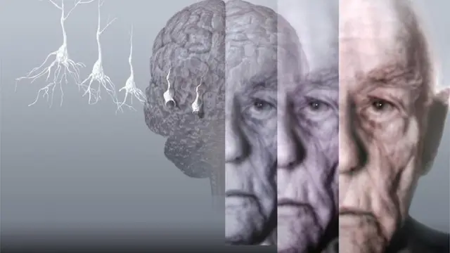 Не пропустіть! Вчені назвали початкові ознаки хвороби Альцгеймера